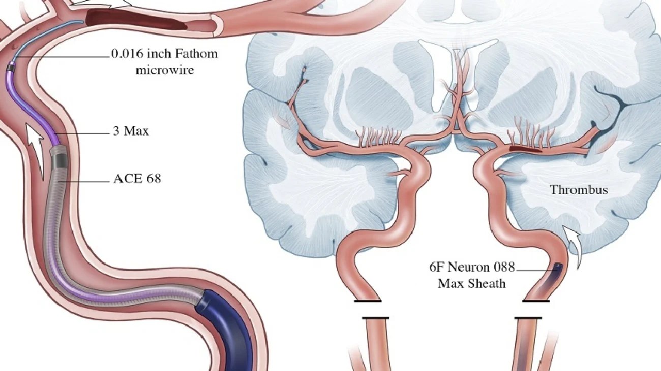 4.5 Minute Thrombectomy Using the ADAPTFAST Technique and the ACE68