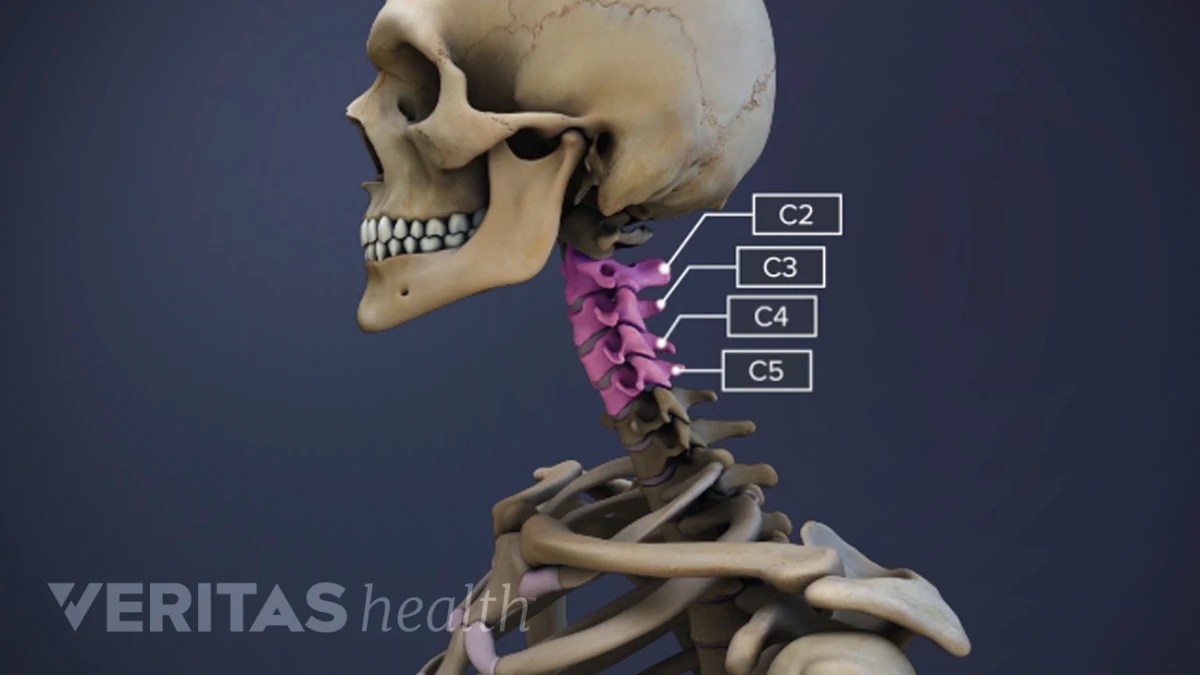Cervical Disc Herniation C3 C4