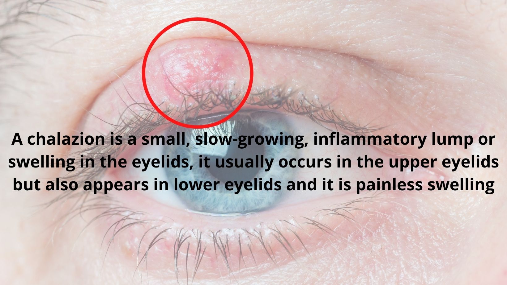 Best Homeopathic treatment for chalazion treatment in delhi