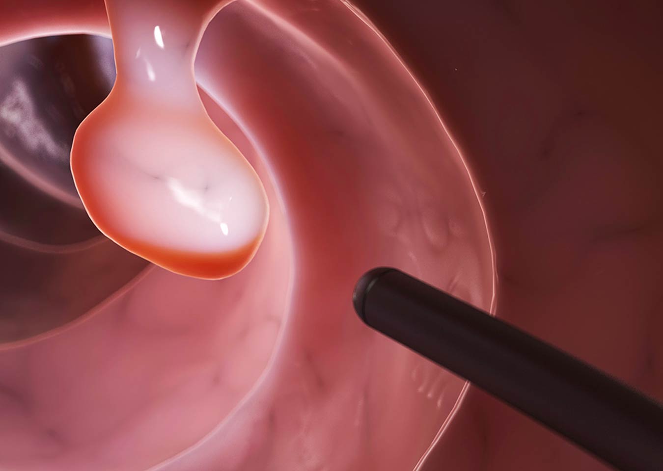 Virtual Colonoscopy Holston Medical Group