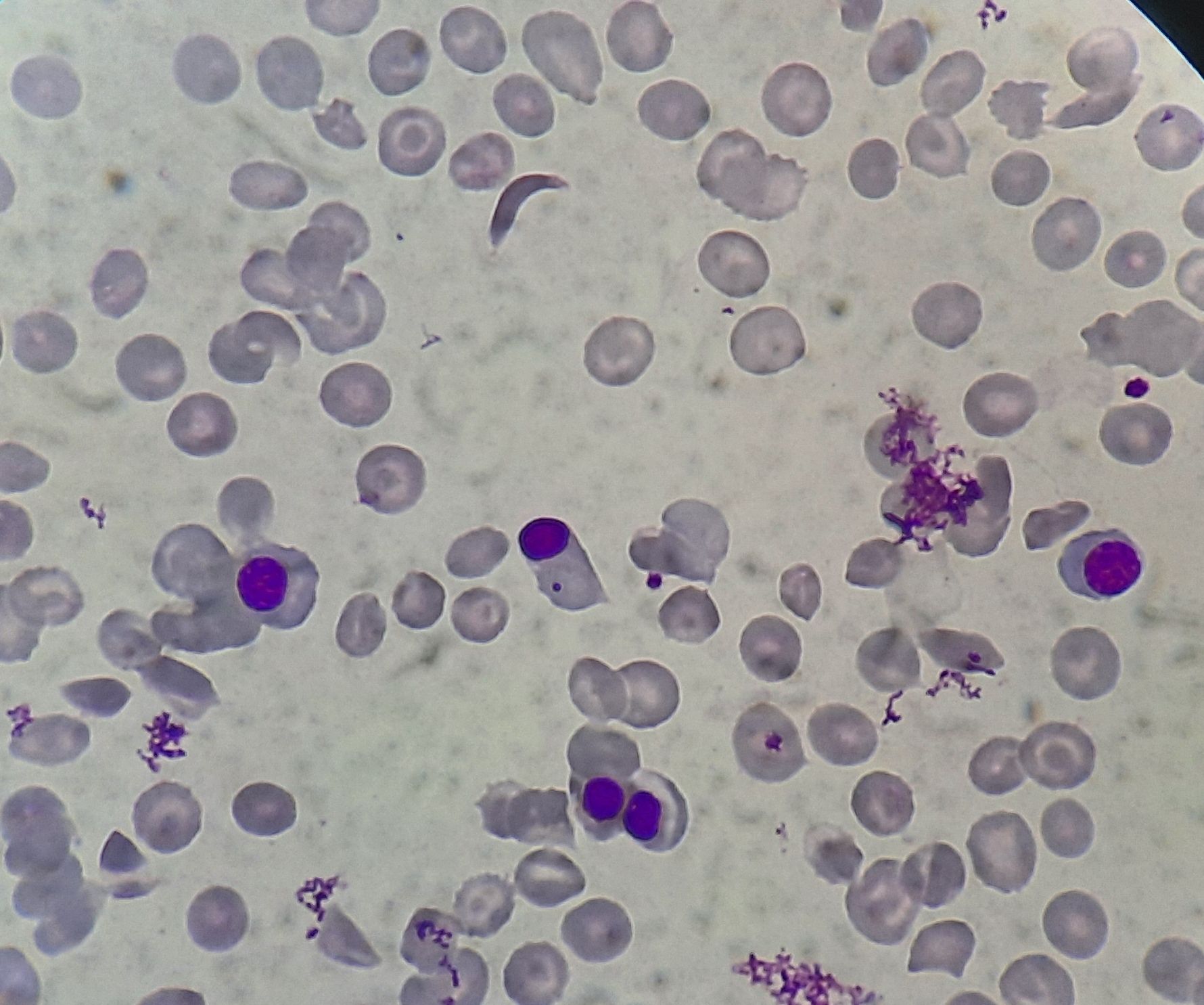 Sickle Cell Anemia howitreat.in