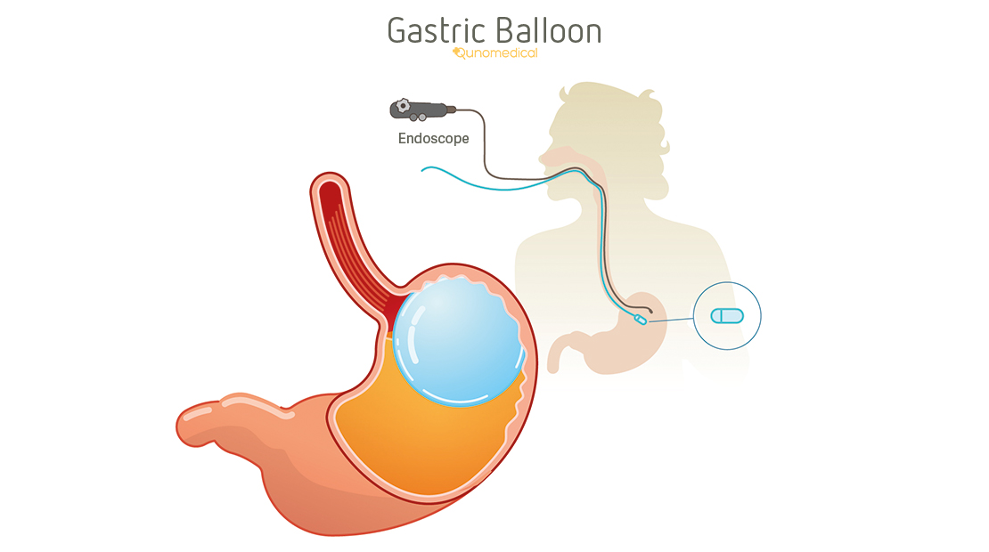 Balloon For Weight Loss Reviews BMI Formula