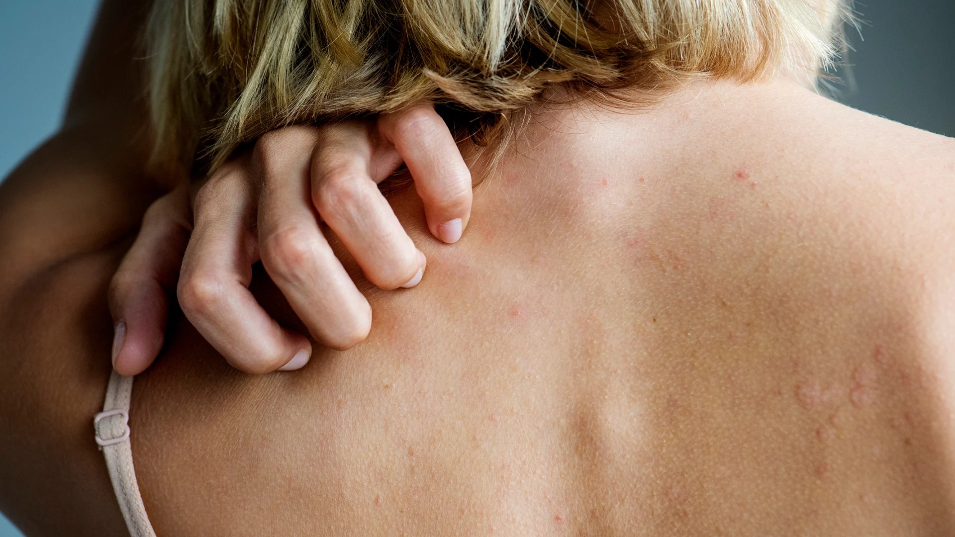 How Long Can a Shingles Rash Last? Sharecare