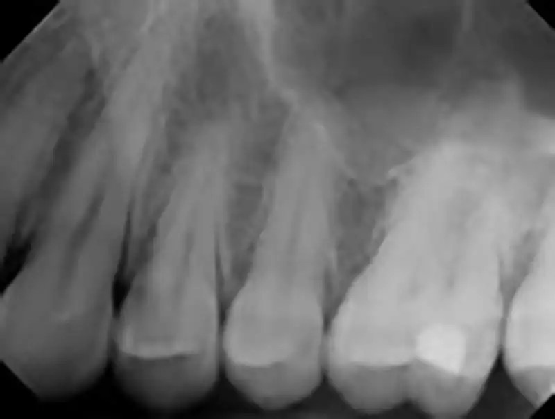 How to interpret dental Xrays 3 Essential Methods