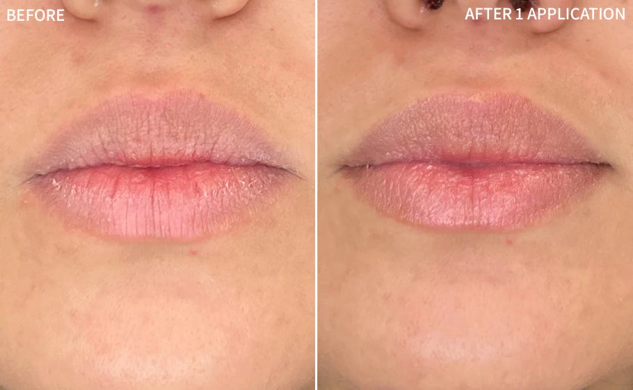 Dry Lips 1 Application