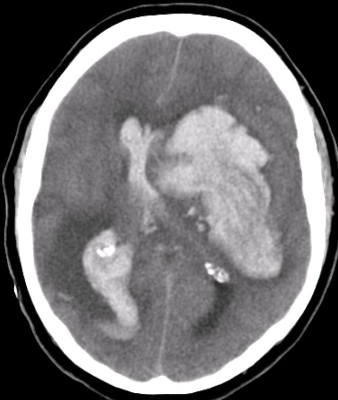 Brain Bleed Brain Bleed On Ct
