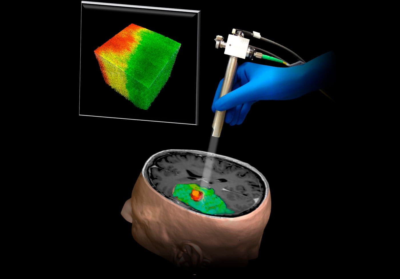 Removing brain cancer using nonlabelling, quantitative optical imaging