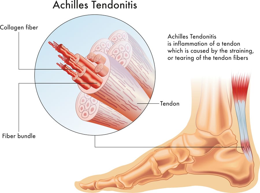Tendons a cornerstone for movement How does research help heal injuries?