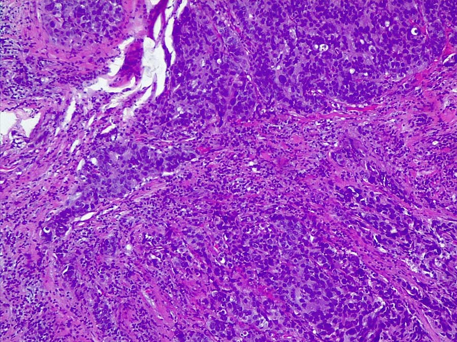 Placental immune editing switches (PIES) and cancer progression