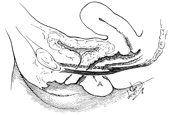 Clinical Anatomy of the Vulva, Vagina, Lower Pelvis, and Perineum GLOWM