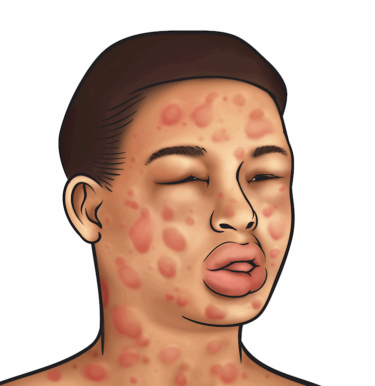 Online Anaphylaxis Training Course reed.co.uk