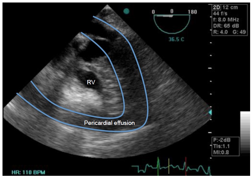 Cardiac Tamponade Virtual Library