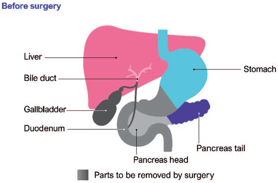 Perioperative Management and Anaesthetic Considerations for Pancreatic