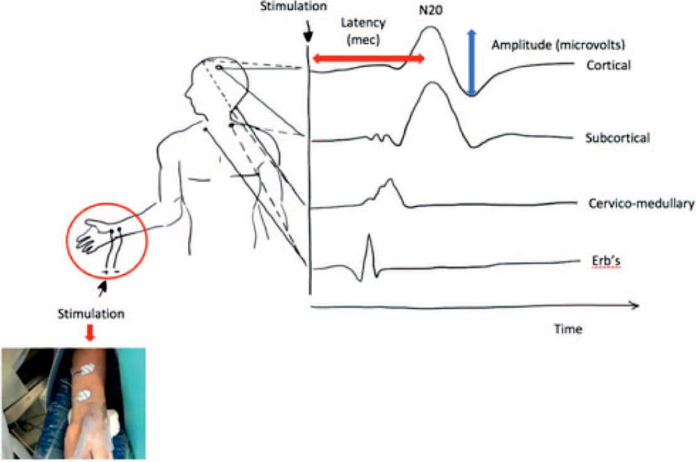 Introduction to Intraoperative Neurophysiological Monitoring for