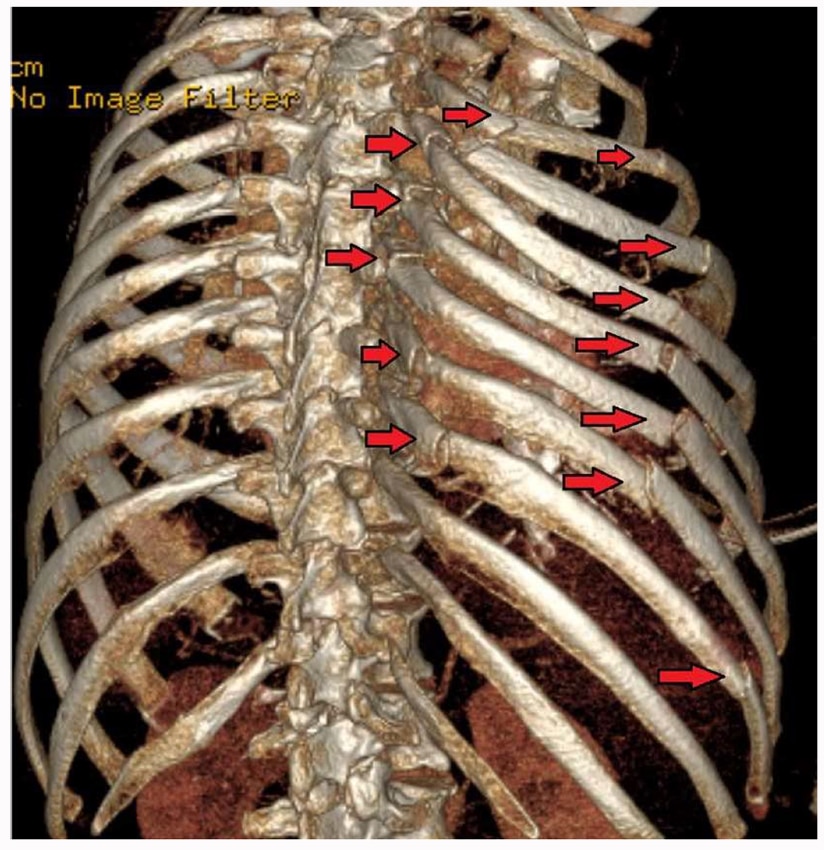 Management of Traumatic Rib Fractures WFSA Resources