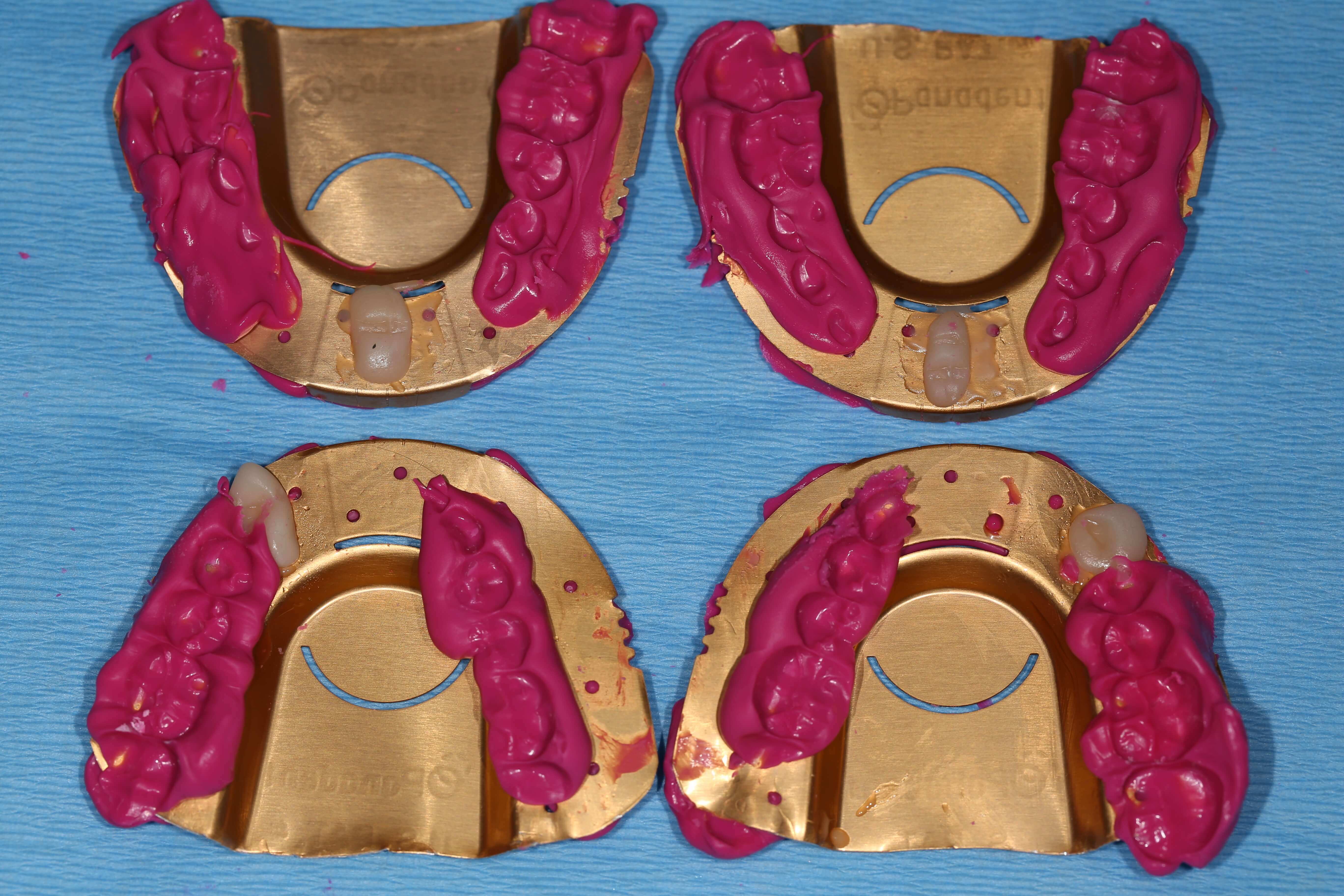 Panadent Copper Tray Bite Records Restorative Nation