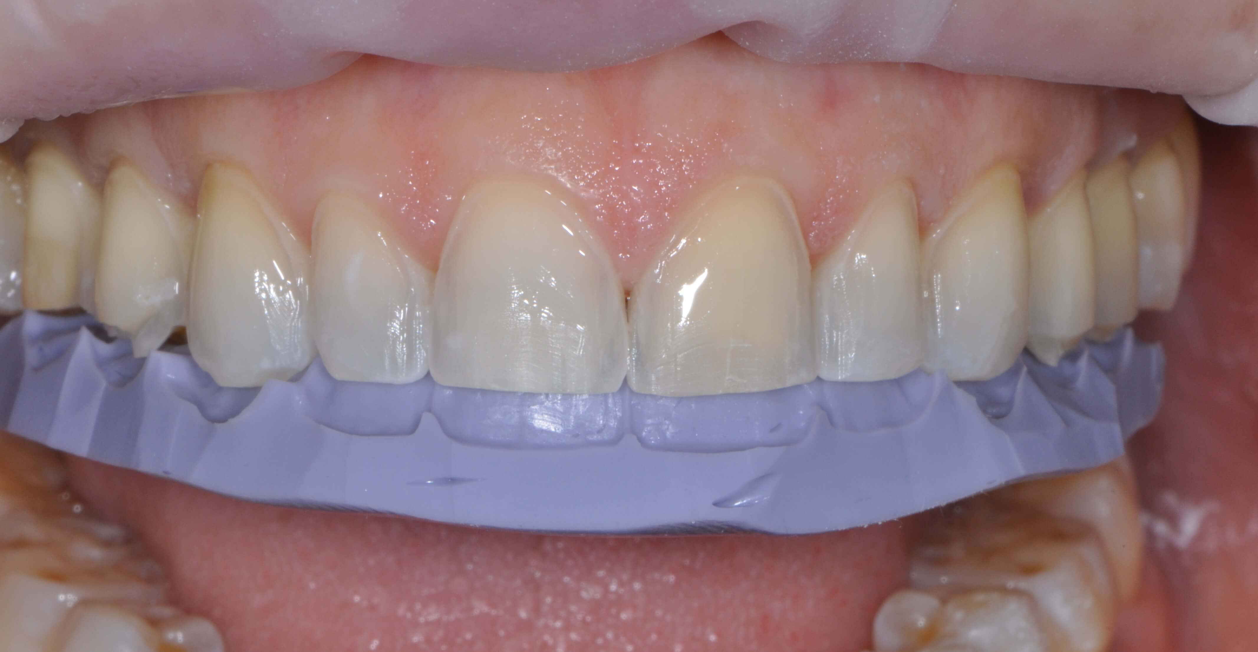 Porcelain Veneers When To Cover The Incisal Edge Restorative Nation