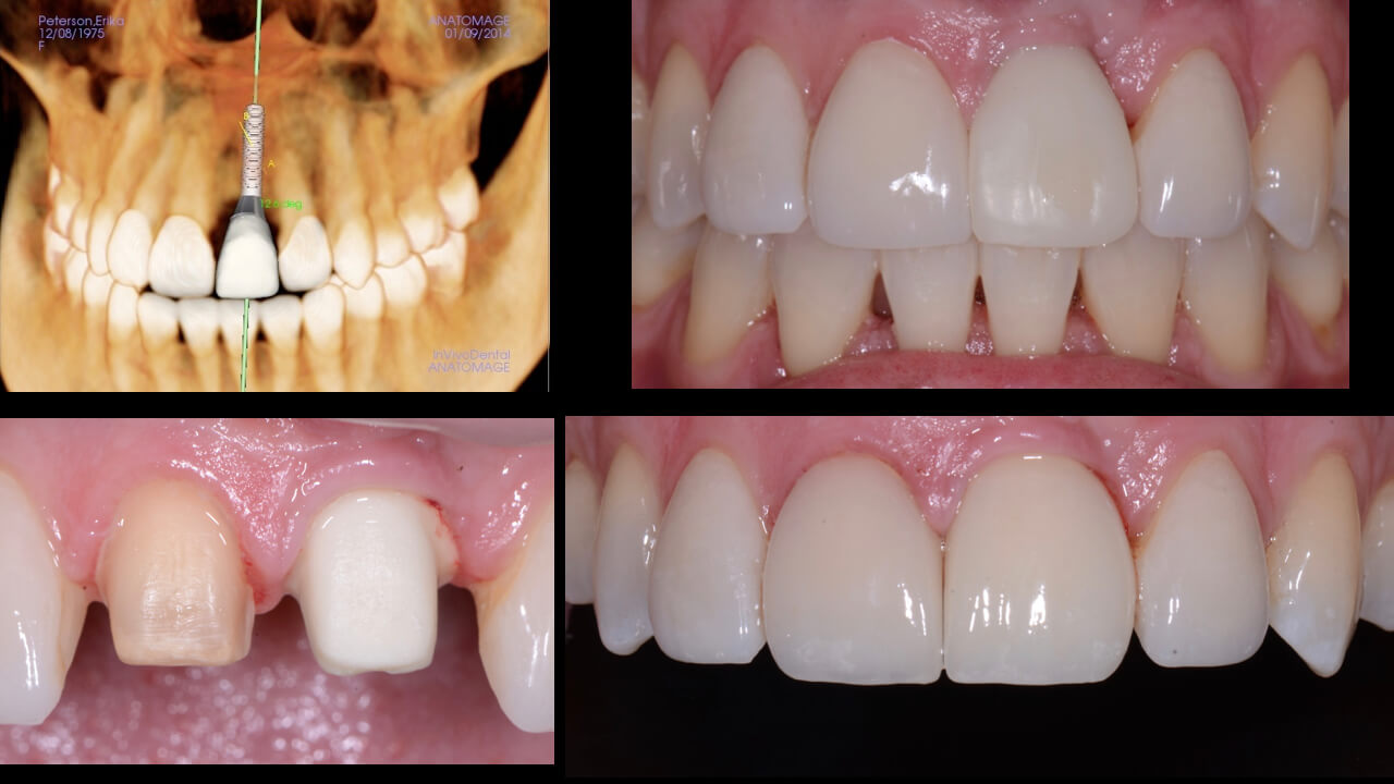 Measuring Dental Implant Success Using PES/WES Scores Restorative Nation