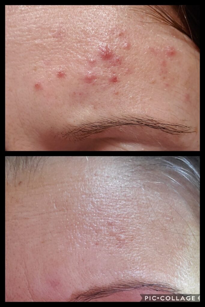 Poly Blue Light Therapy Restorative Spot