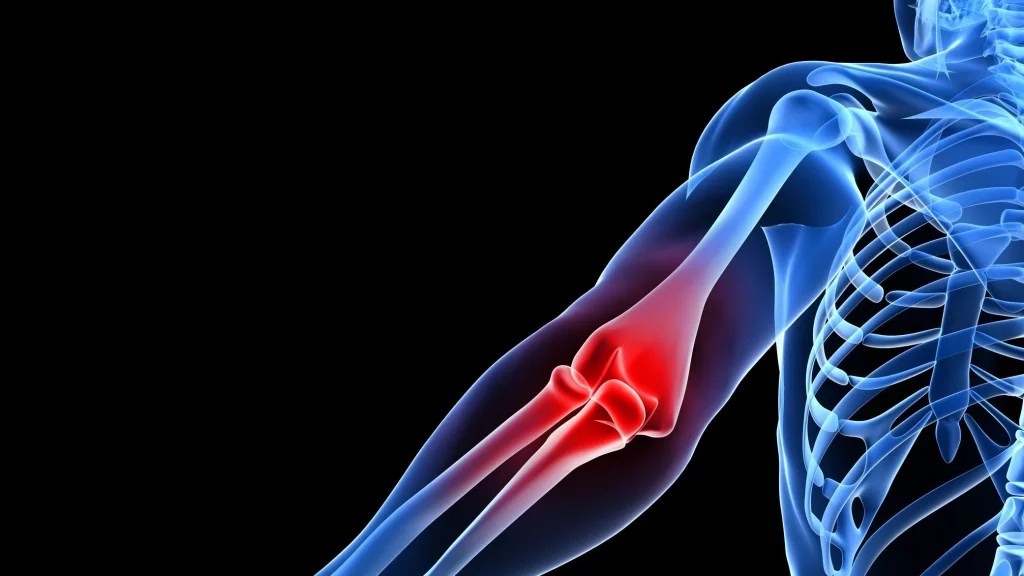 Forestalling and Treating Tennis Elbow in Tennis Players