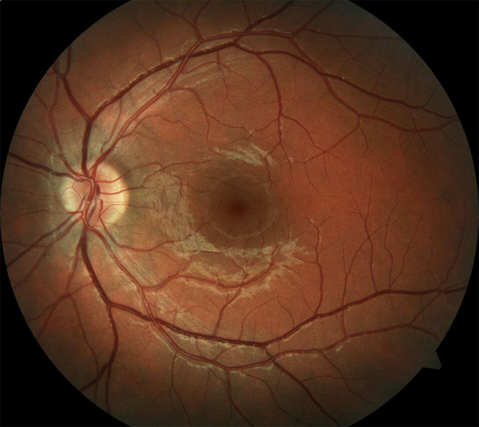 Retinal Detachment Retina & Vitreous of LA