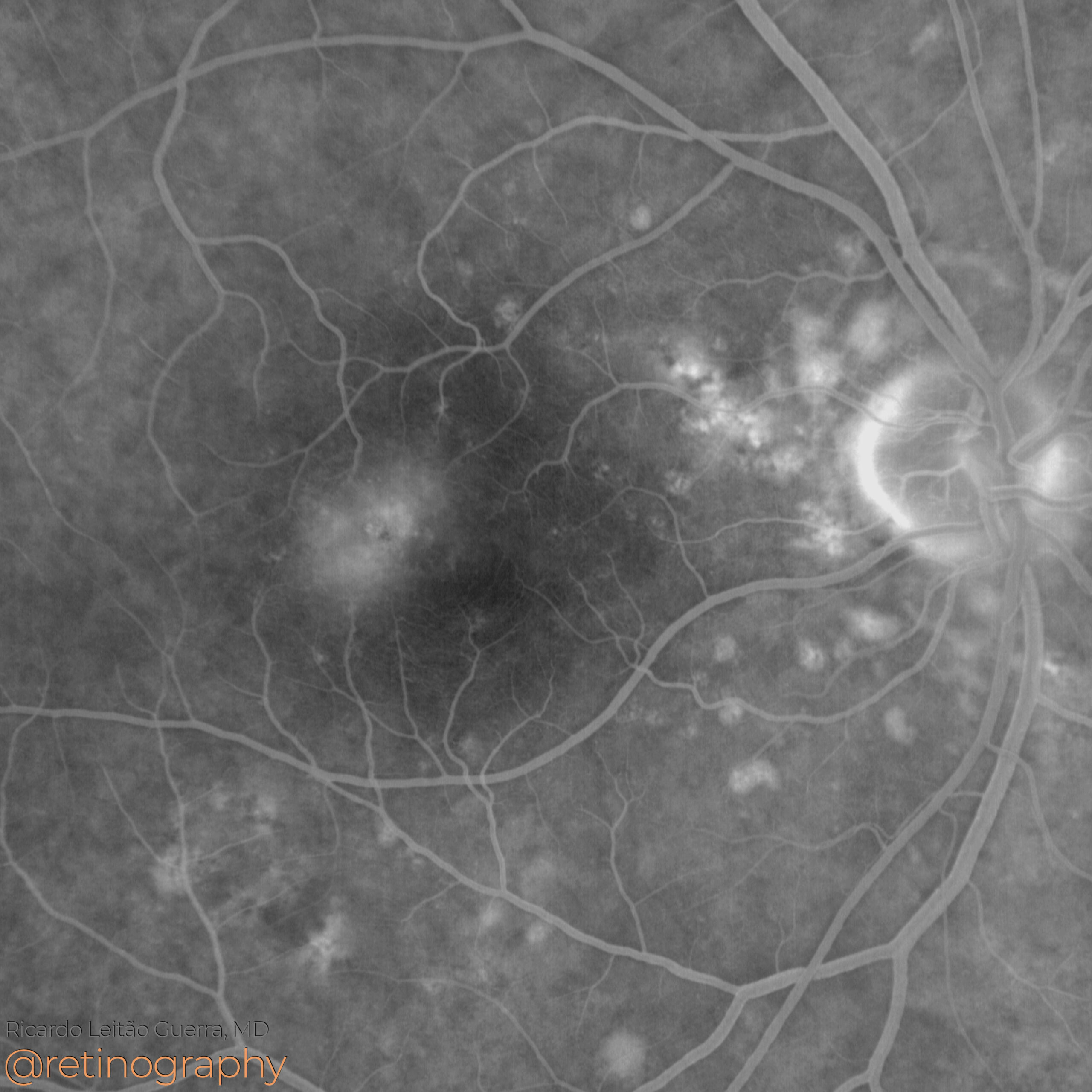 MacTel Type 2 – Retinography