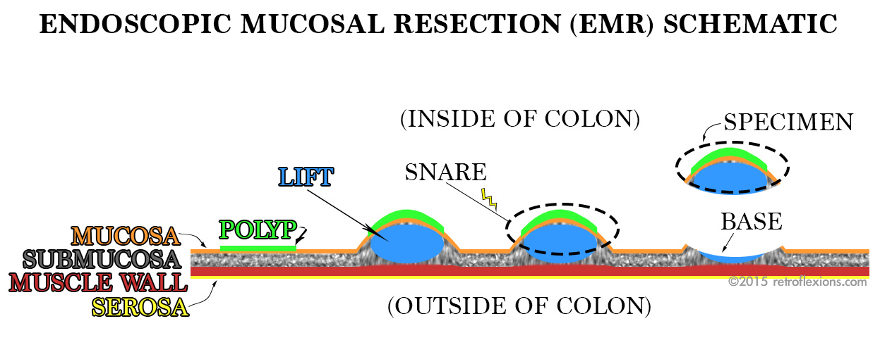 » Intro to endoscopic mucosal resection (EMR).