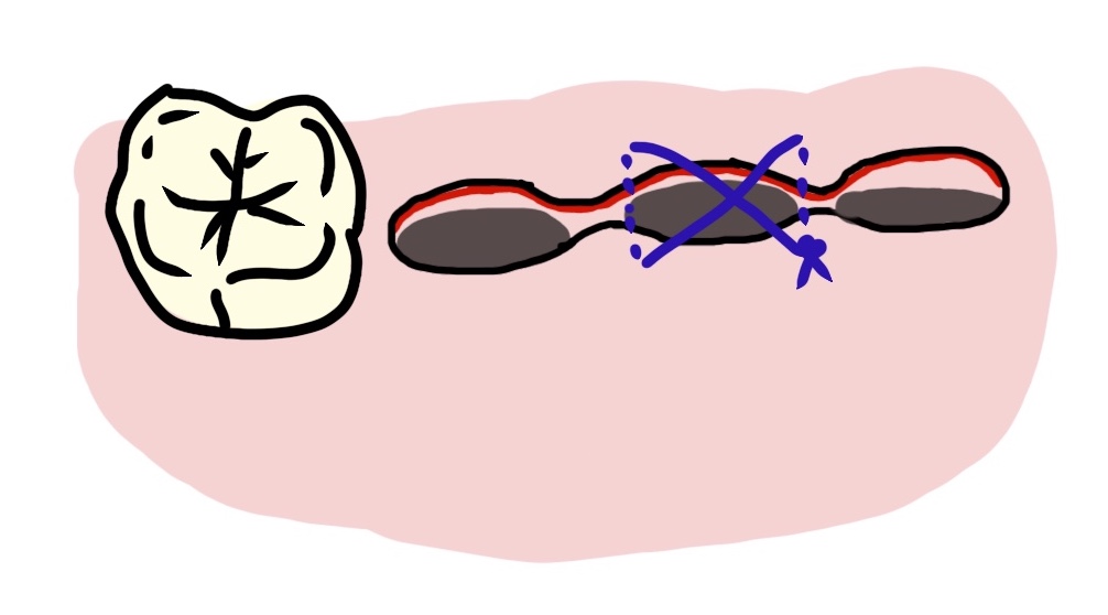Surgical Extraction Procedure & Sutures Revise Dental