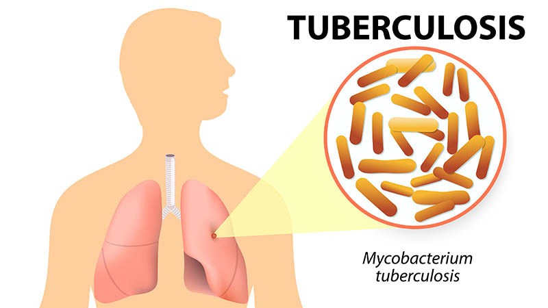 Tuberculosis, la enfermedad que puede causar daño permanente en los