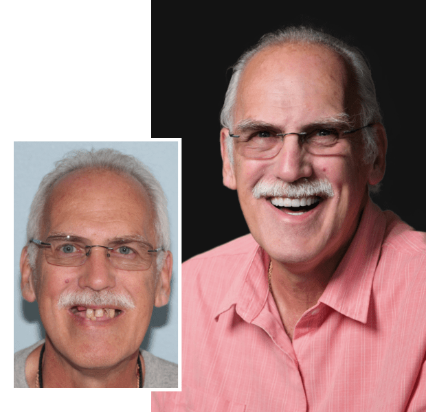 ALLON4® Dental Implants Mesa, AZ Revive Dental Implant Center