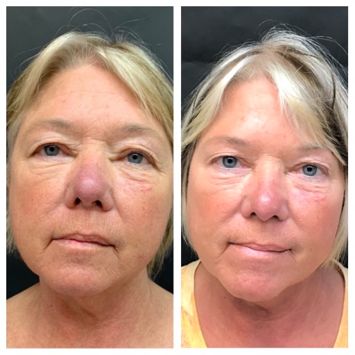 Scarlet SRF Facial Treatment Revivify Medical Spa