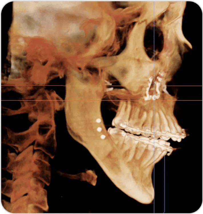 Double Jaw Surgery Relapse 1 Movahed OMS