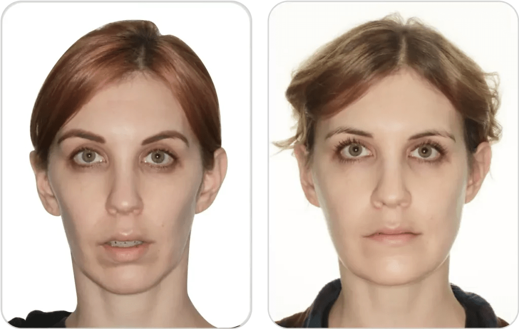 Double Jaw Surgery Relapse 1 Movahed OMS