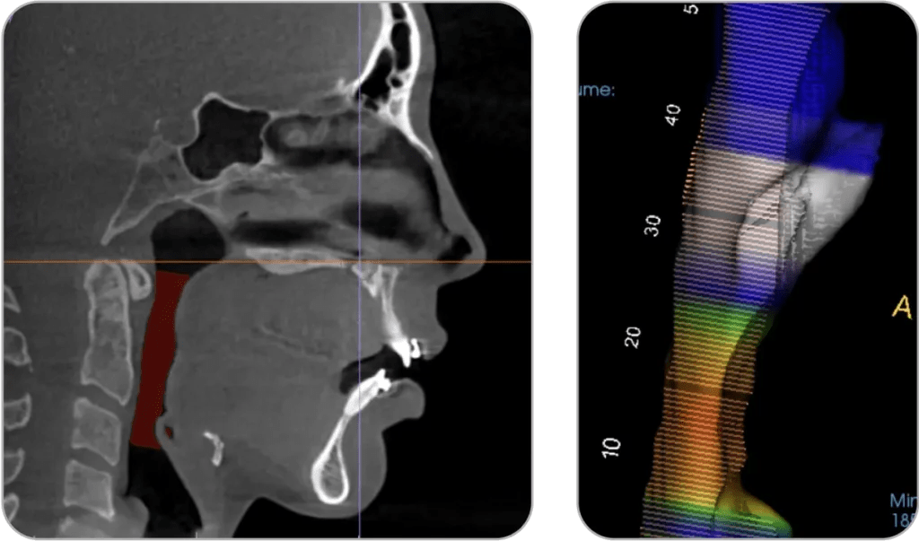 Double Jaw Surgery Relapse 1 Movahed OMS