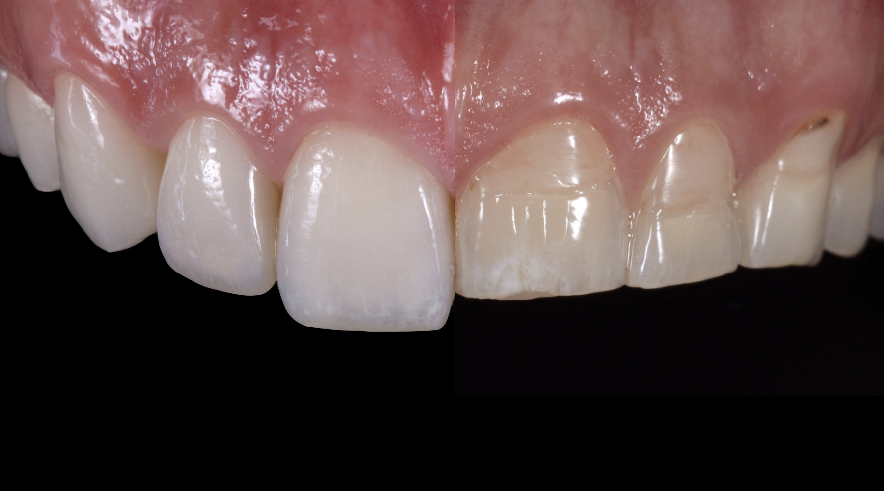 Patient Oriented Treatment Concept for Pathological Tooth Wear