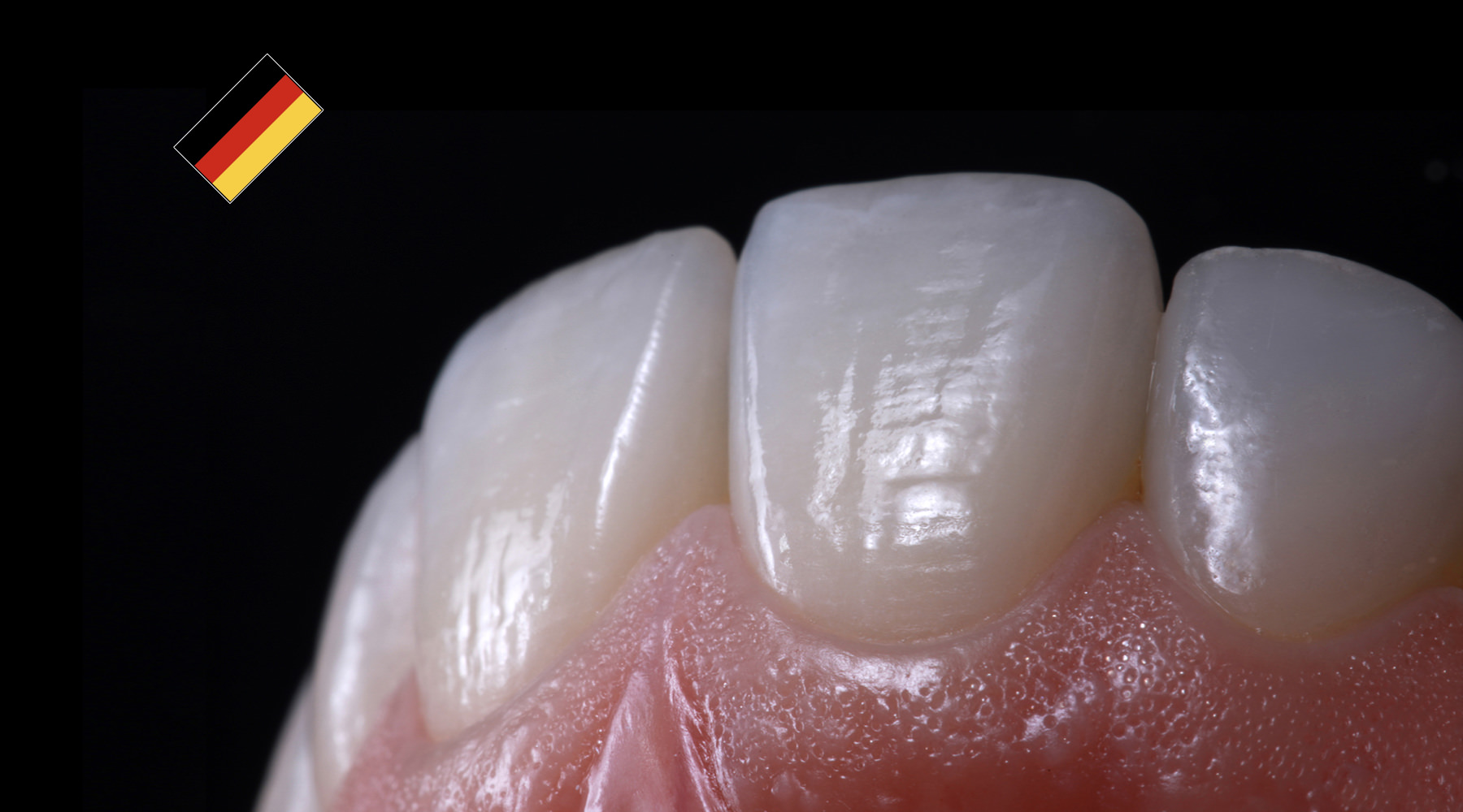 Anterior restorations The performance of ceramic veneers rezotto