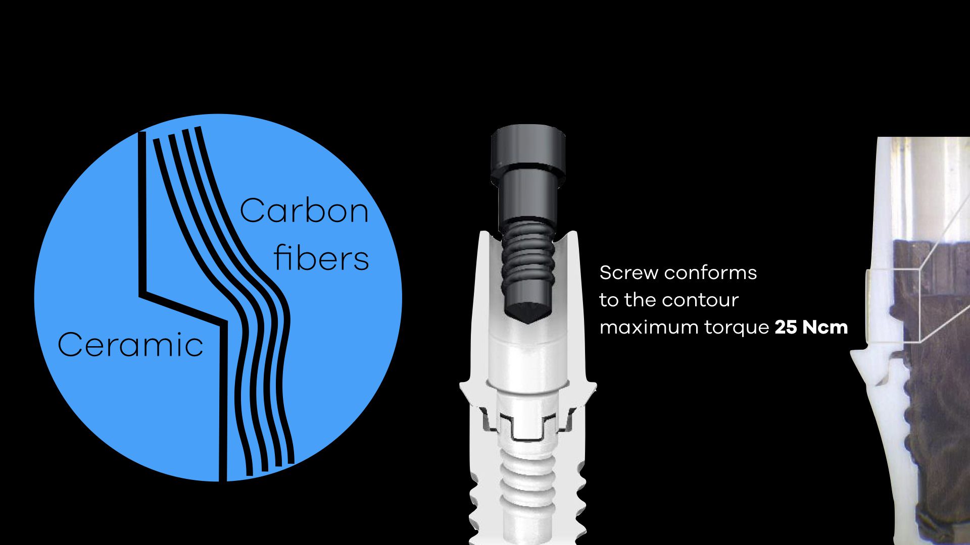 Nobel Biocare Implant for Single Tooth Replacement rezotto production