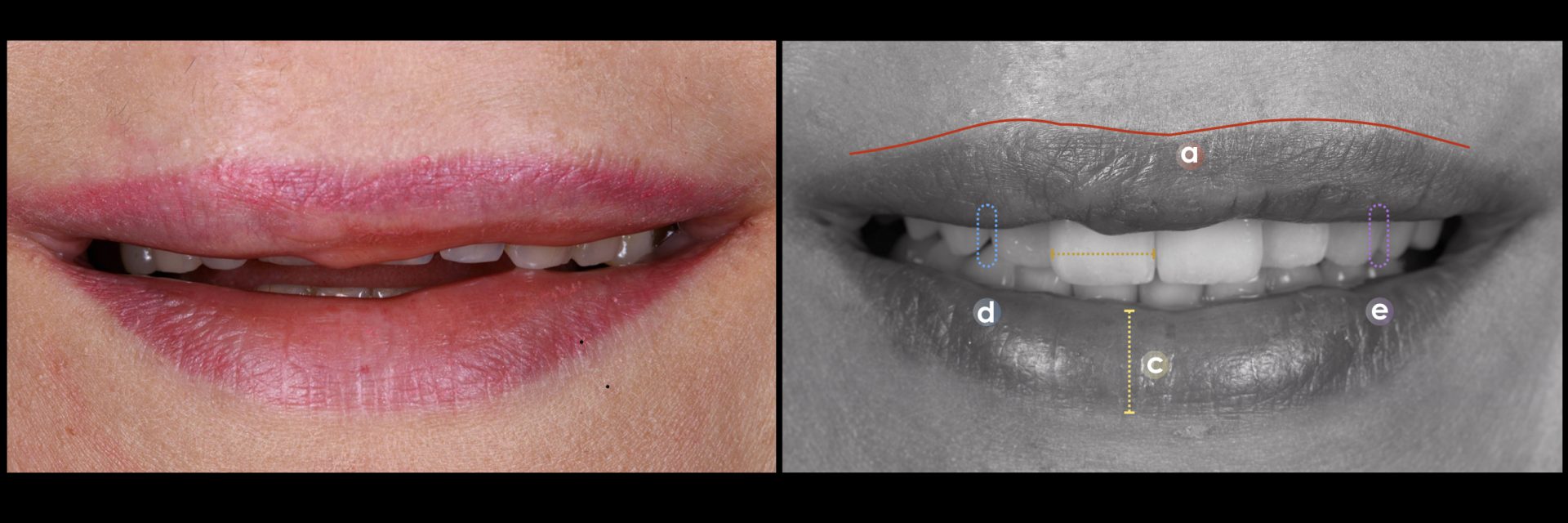 Facial Analysis Video Tutorial for a better Smile Design rezotto