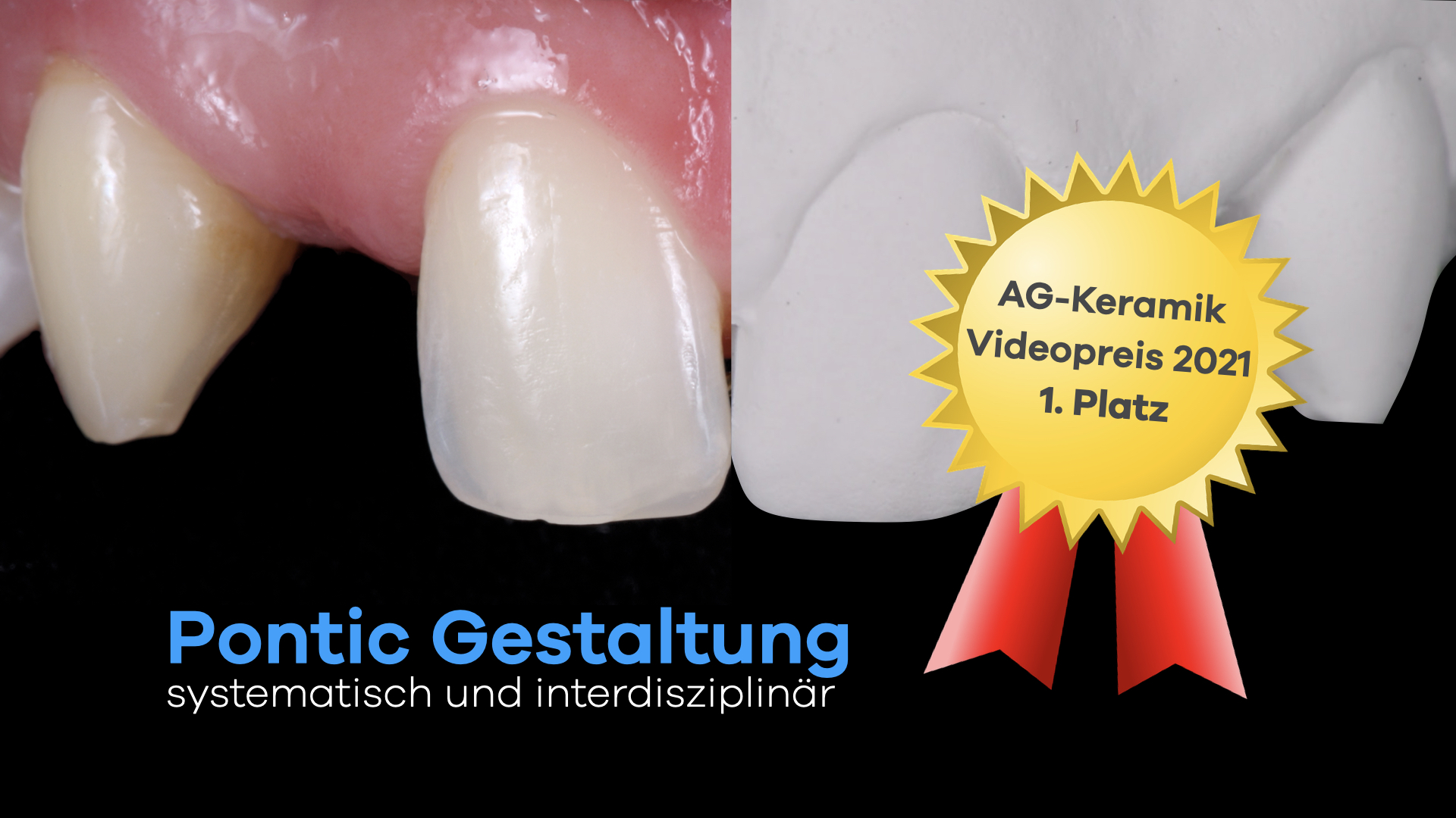 Dental Ovate Pontic at John Ayres blog