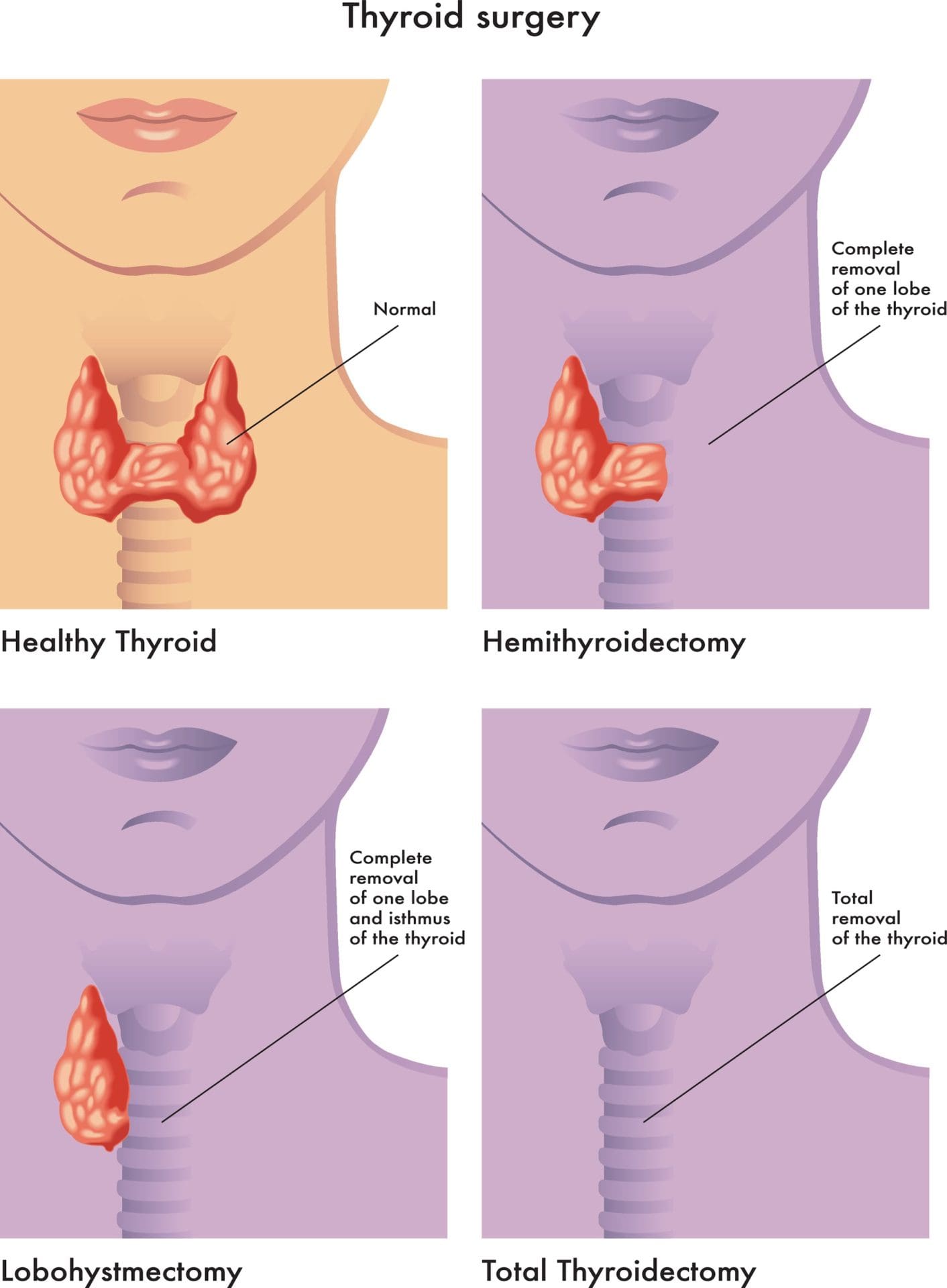 Why Might Thyroid Nodules Need To Be Surgically Removed? RFA For Life