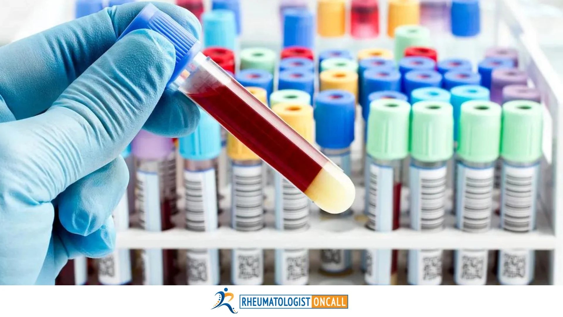 Rheumatoid Arthritis with negative Rheumatoid Factor