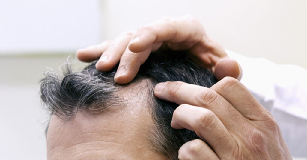 Preparing for Your Hair Restoration Procedure Robotic Hair