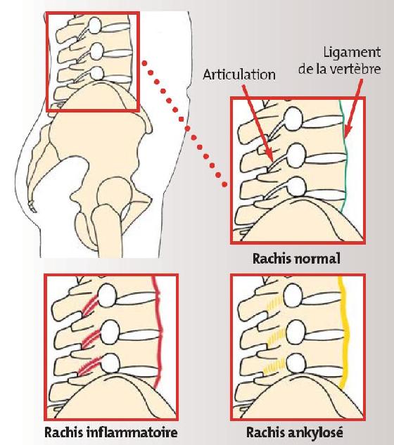 Quels sont les signes de l'atteinte rachidienne