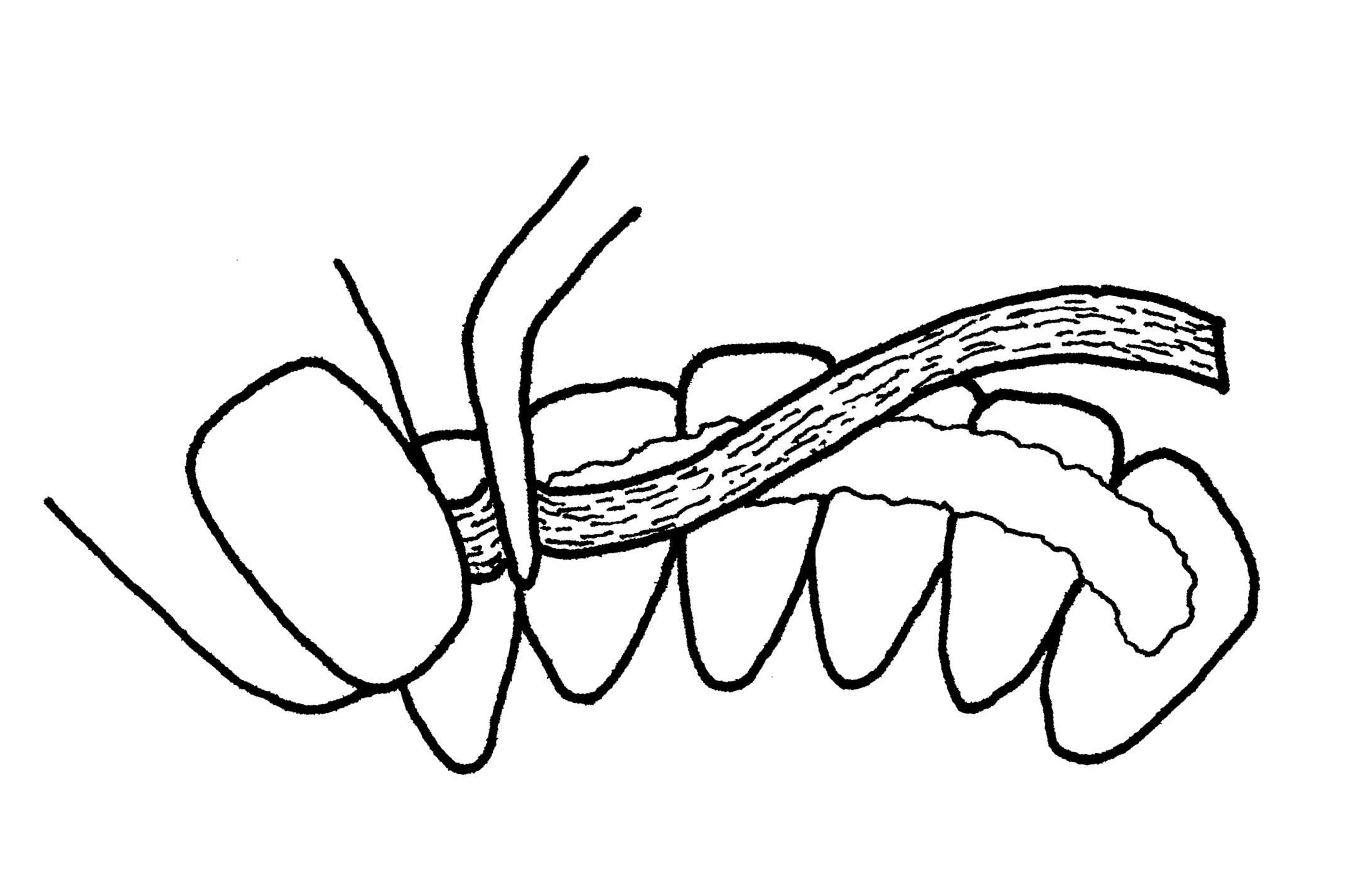 Periodontal Splint Clinical Applications Ribbond