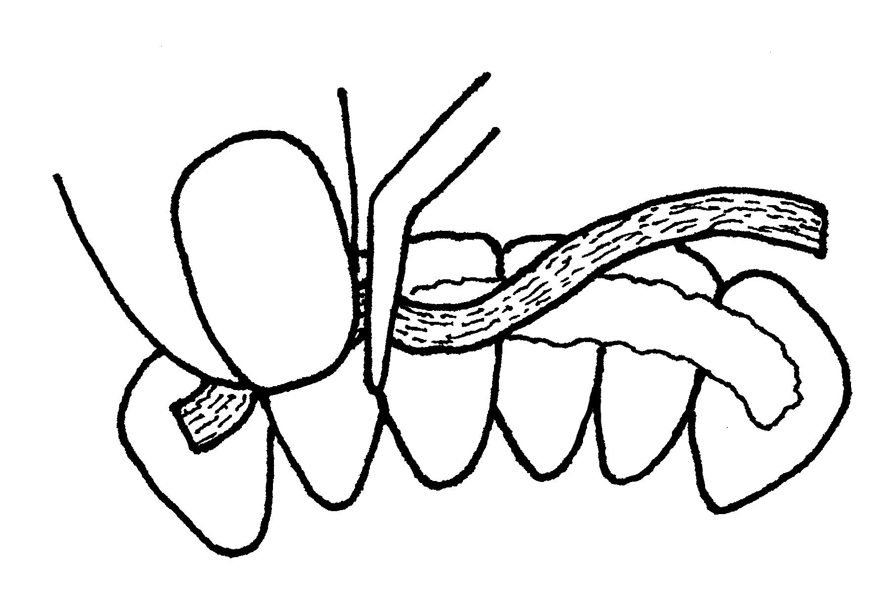 Periodontal Splint Clinical Applications Ribbond