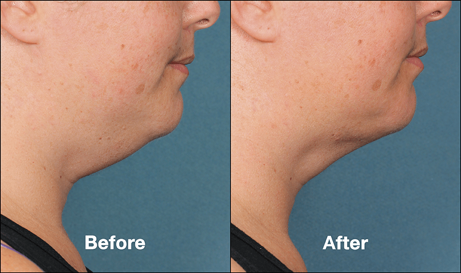Kybella NonSurgical Chin Fat Reduction Las Vegas NV