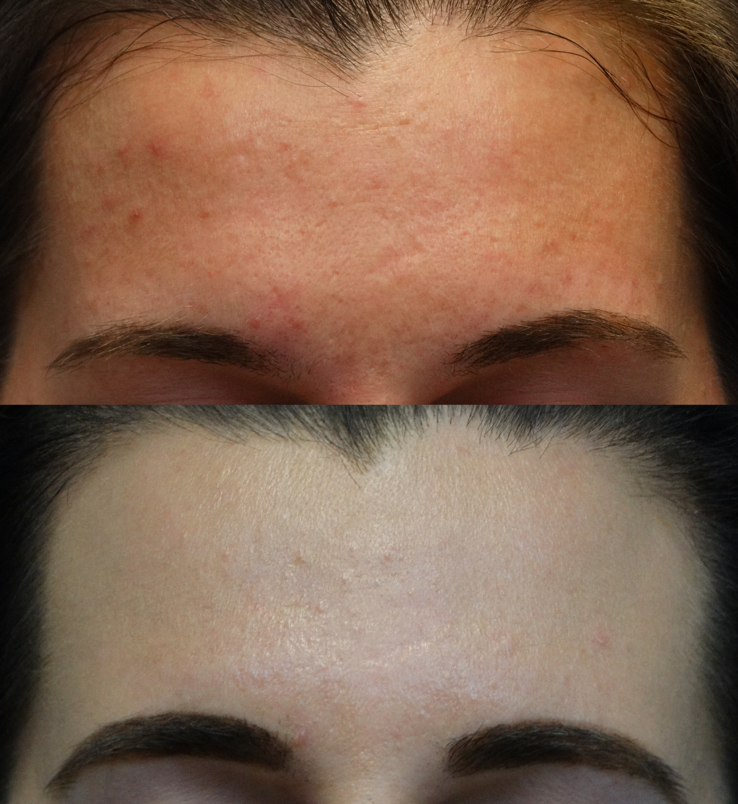 Acne & Rosacea Richmond ENT
