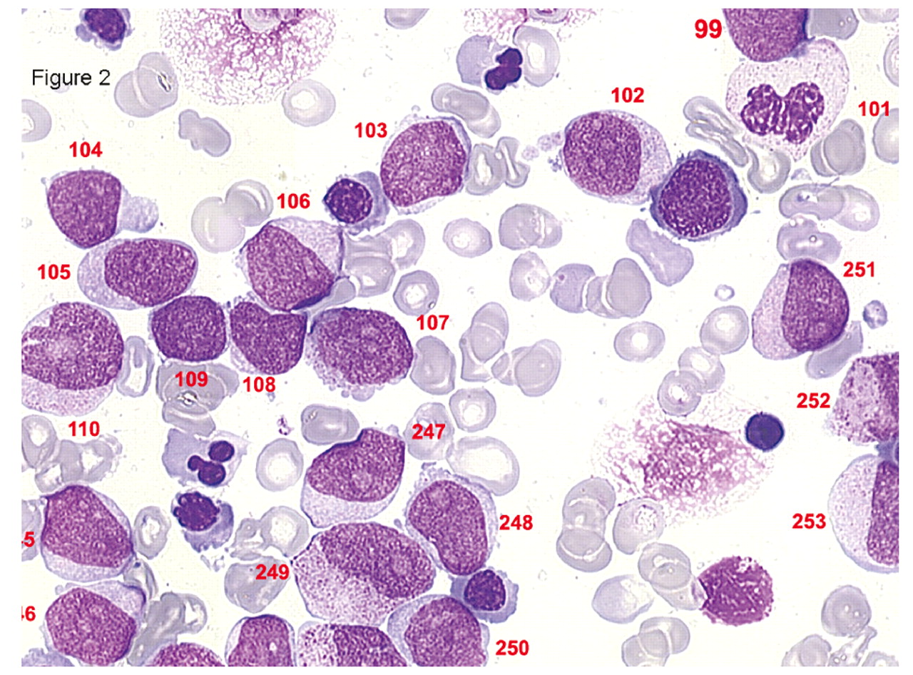 Myelodysplastic Syndromes; Dysmyelopoietic Syndromes