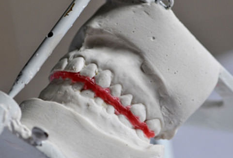 구성교합 판교 치아교정