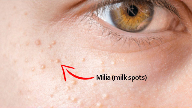 Milia on Face How to Get Rid of Milia on Face at Home Easily